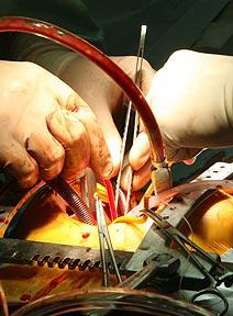 Thoracic-Surgery-Open-Heart-MedSpark